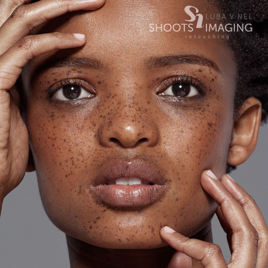 Why do freckles come out in the sun? | HowStuffWorks