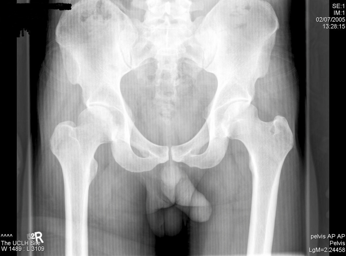 Penis X Rays 17