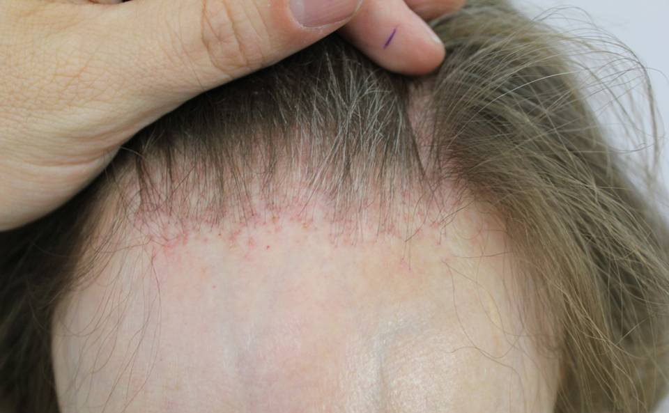Frontale fibroserende alopecia - Wikipedia