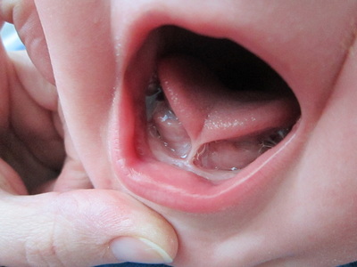 When Your Baby Is Born With Teeth: Natal Teeth | Oral Answers