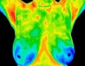 Breast Thermography – Breast Cancer Screening Without Radiation